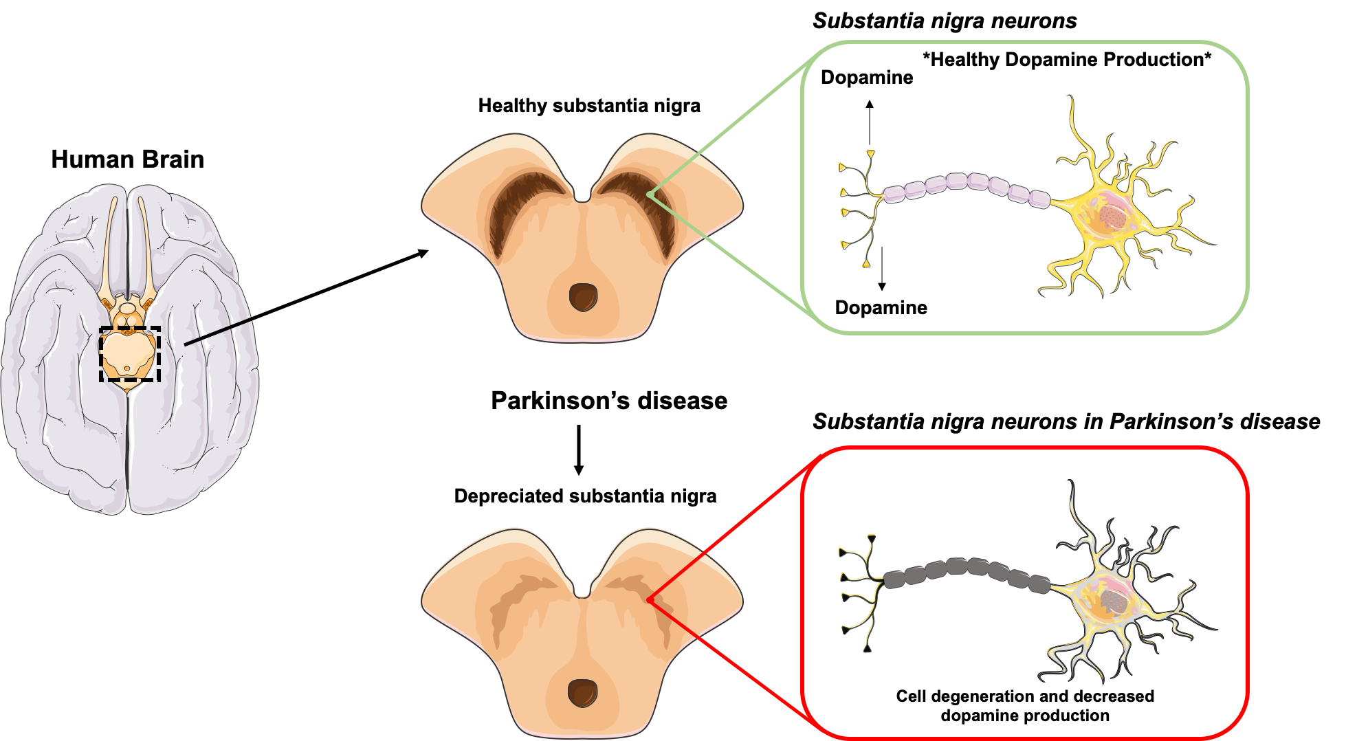 Dopamine & Parkinson's Disease: The Link Between